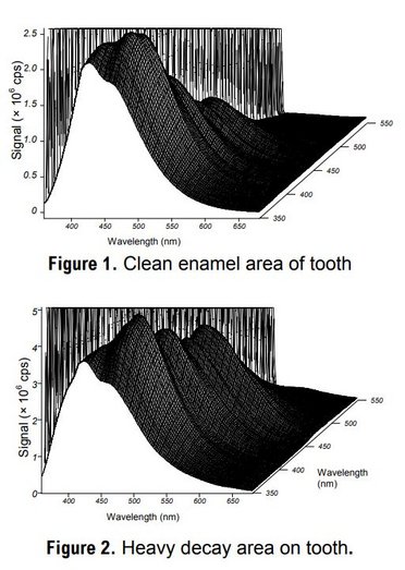 Characterizing Tooth Decay with Fluorescence Introduction